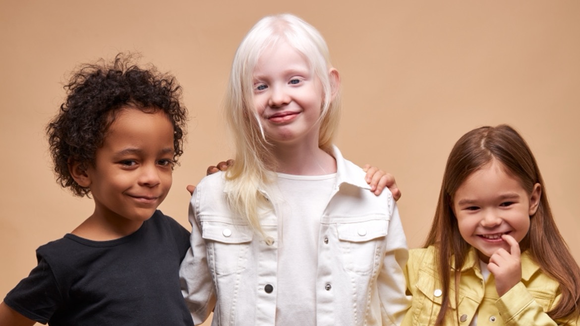 Dia Internacional da Conscientização do Albinismo