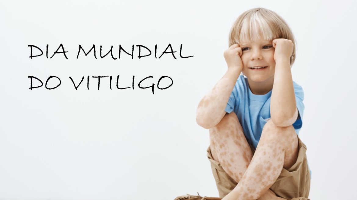 Vitiligo – Sintomas, Diagnóstico e Tratamento